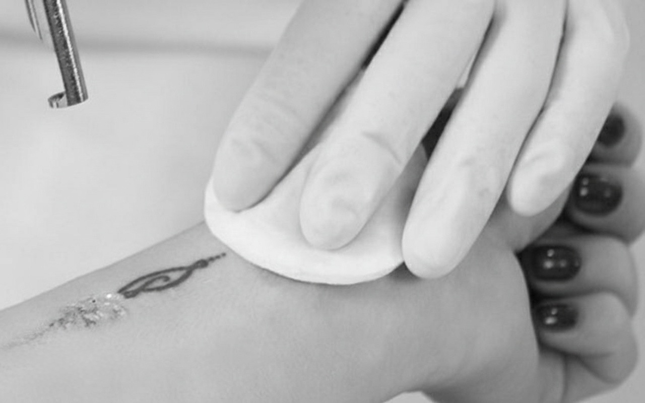 Laser removal